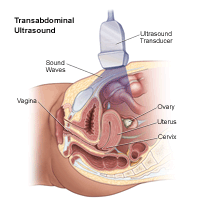 Click Image to Enlarge Illustration of a transabdominal ultrasound procedure