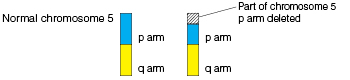 Normal chromosome with p arm and q arm, compared to chromosome with part of p arm deleted.