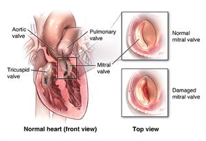 Front cut view of the heart. A healthy mitral valve and a damaged mitral valve are shown in insets. 