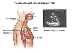 Side view of male torso showing transesophageal echocardiogram (TEE) transducer placement in esophagus with inset of echocardiogram.