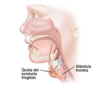 Vista lateral de la cabeza y el cuello de un niño donde se observa el quiste del conducto tirogloso.
