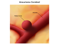 Ilustración de un aneurisma intracraneal