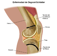 Ilustración de la enfermedad de Osgood-Schlatter