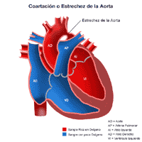 Anatomía de un corazón con coartación de la aorta