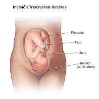 Ilustración de una incisión transversa de cesárea