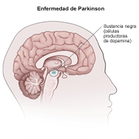 Ilustración que muestra cómo la enfermedad de Parkinson afecta al cerebro