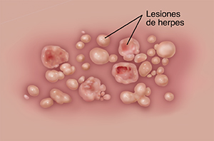 Primer plano de lesiones de herpes genital en la piel.