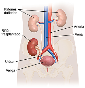 Vista frontal del aparato urinario con los riñones, los uréteres, la vejiga y la uretra, donde se observa la posición de un riñón trasplantado.