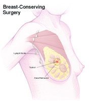 Click to Enlarge Illustration that explains breast-conserving surgery