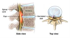 Side and top view of vertebra with herniated disc.